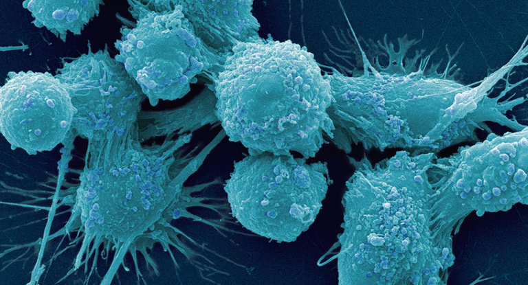 human prostate cancer cells
